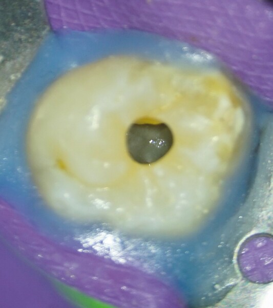Figs. 7a et b : (a) Les photographies cliniques de la dent juste avant le début du traitement endocanalaire et (b).juste après la préparation du puits d’accès endodontique. 