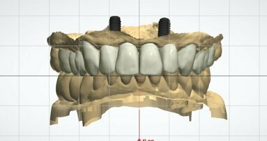 Piano di trattamento clinico con utilizzo di progetto digitale complesso su edentulie estese di entrambe le arcate dentarie