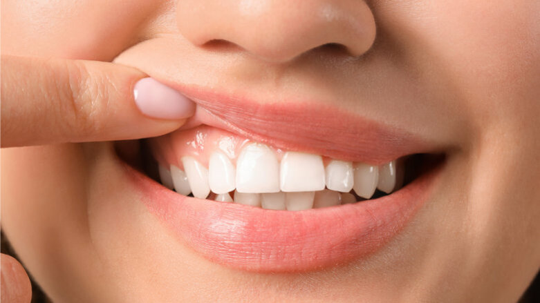 „Gingiva-Bleaching“ gegen dunkle Zahnfleischverfärbungen