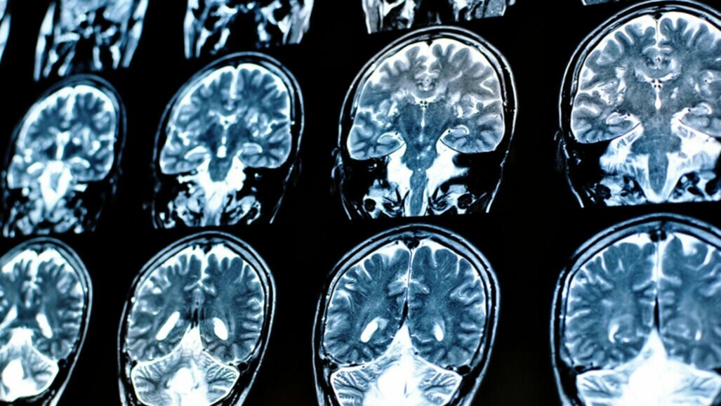Nieuwe studie suggereert verband tussen hersenfunctie en mondgezondheid