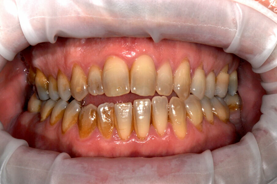 Fig. 6 - Fotografia frontale scattata prima della seduta di igiene orale professionale (Guided Biofilm Therapy).