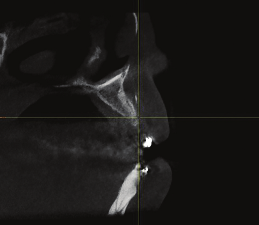 Figure 29: 5 months postoperative CBCT cross-sectional view revealed bone growth insuring an adequate placement of implant in an ideal position.