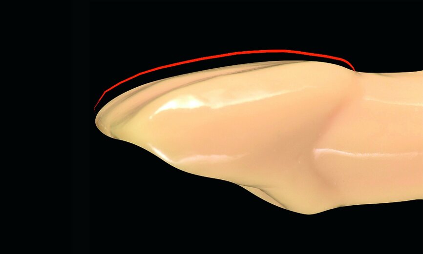 Fig. 4: Acceptable round-convex no-preparation veneer margin with a little thickness.