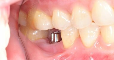 Mais de 60 por cento dos dentistas realizam procedimentos de implante dentário