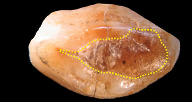 Stone-age dental filling identified