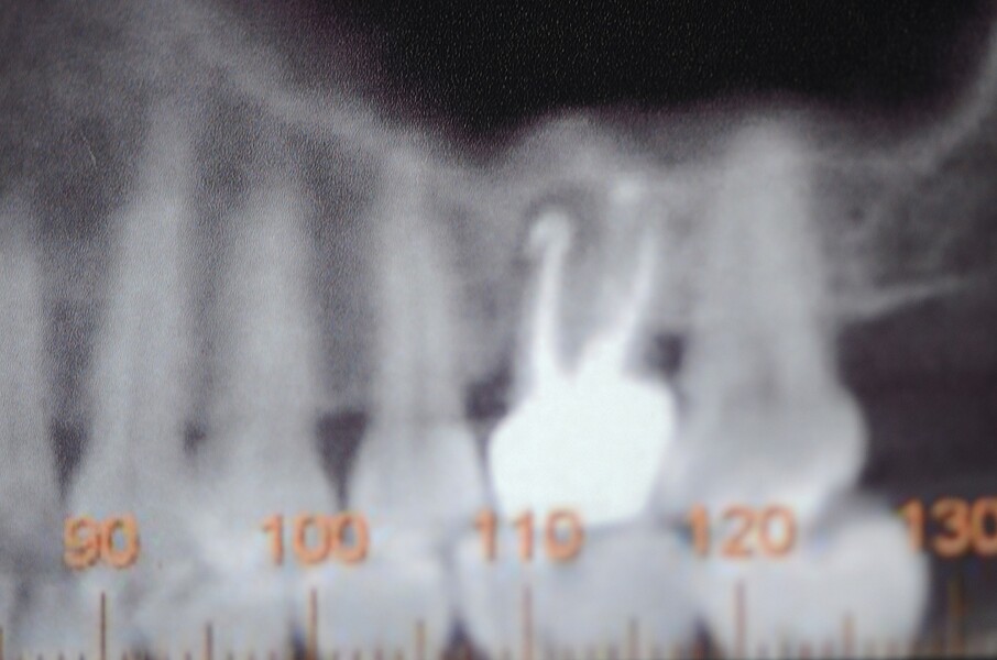 Fig. 1 : Radiographie avant l’extraction (première phase).