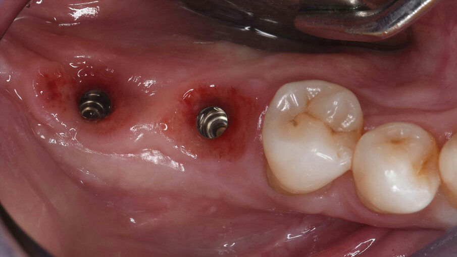 Fig. 15_Immagine clinica dopo condizionamento dei tessuti molli peri-implantari.