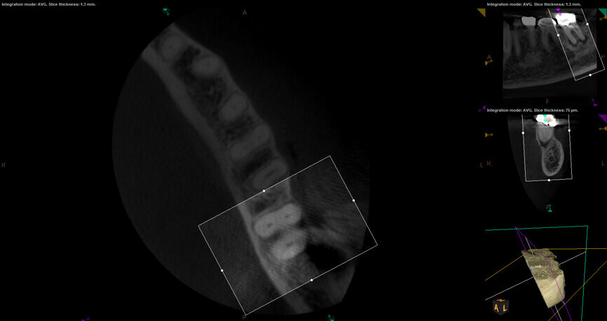 Fig. 17b: Case assisted with CBCT to determine anatomy pre-operatively. Note the multiple cross sections moving apically and the correlation to the 2-D view. Note also the conservative taper in relation to the root width. (Courtesy of Dr. Brett Gilbert)