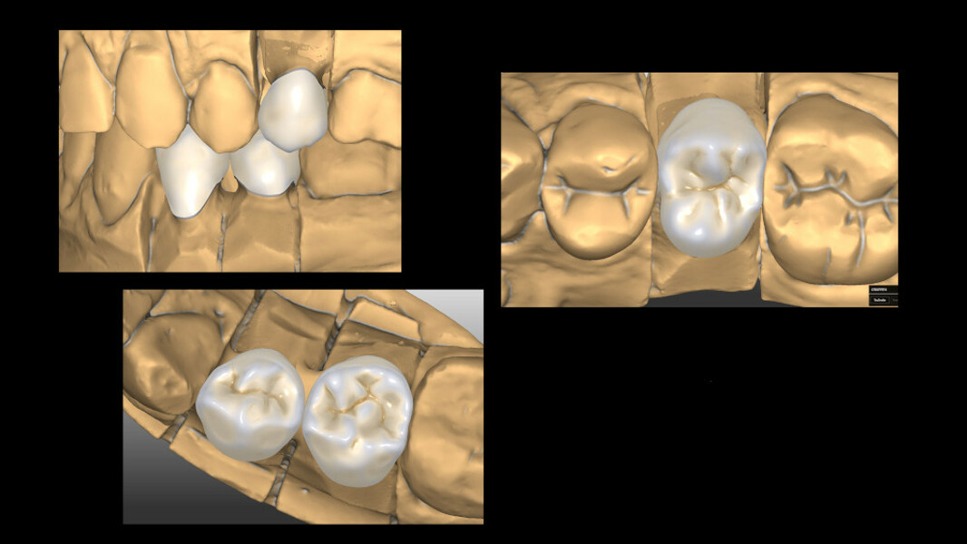 Fig. 7: CAD construction of the fully anatomical individual crowns.