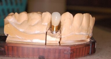 Prace z kompozytów technicznych na implantach stomatologicznych