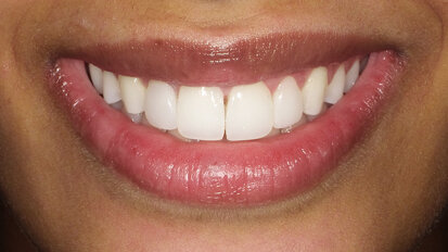 Meeting patients' needs and transforming smiles with direct veneers