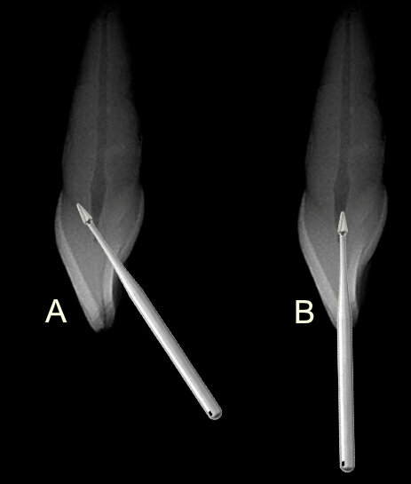 Fig. 6: A potential problem when attempting to access the orifice in anterior teeth is an approach at the middle of the lingual surface with an angle not following the root’s long axis that can lead to perforation of the tooth on the facial cervical (A), and the bur being used for access should be kept parallel to the roots long axis which often places the orifice under the incisal edge (B). 
