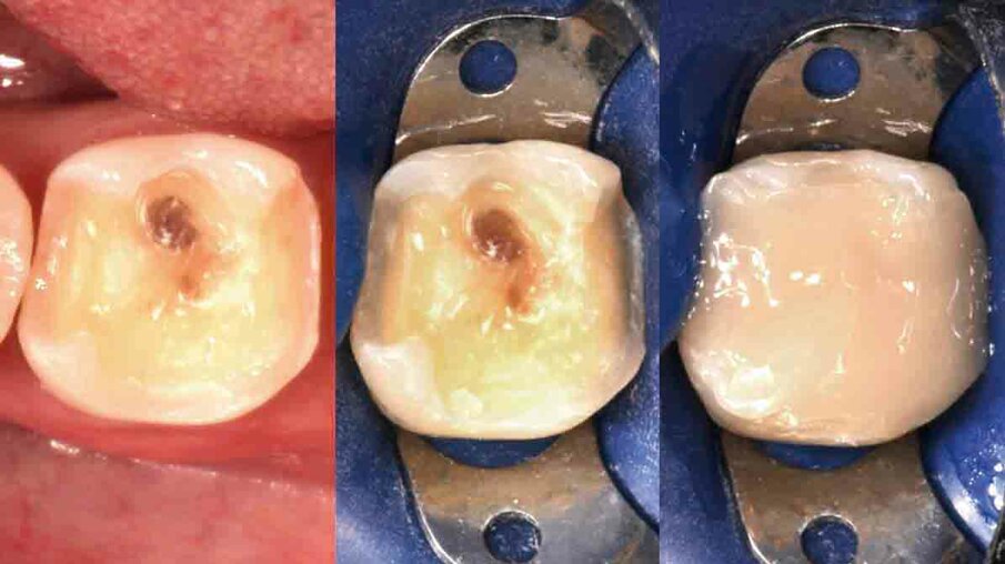 Fig. 3: Upon removal of the old filling, it becomes clear that a crown is needed to ensure the required stability. The tooth is built up with  3M™ Filtek™ Bulk Fill Posterior Restorative, which may be placed in conjunction with 3M™ Single Bond Universal Adhesive and in increments of up to 5 mm.