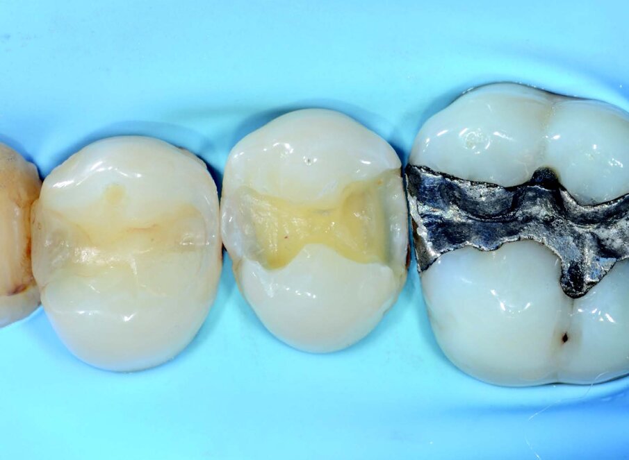 Picture of the cavity after removing the amalgam restoration and after performing the cleaning of cavity.