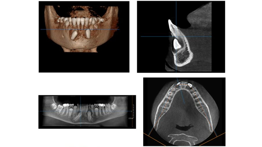 Fig. 7_CBCT: a) visione frontale, b) visione sagitale, c) overview, d) visione coronale.