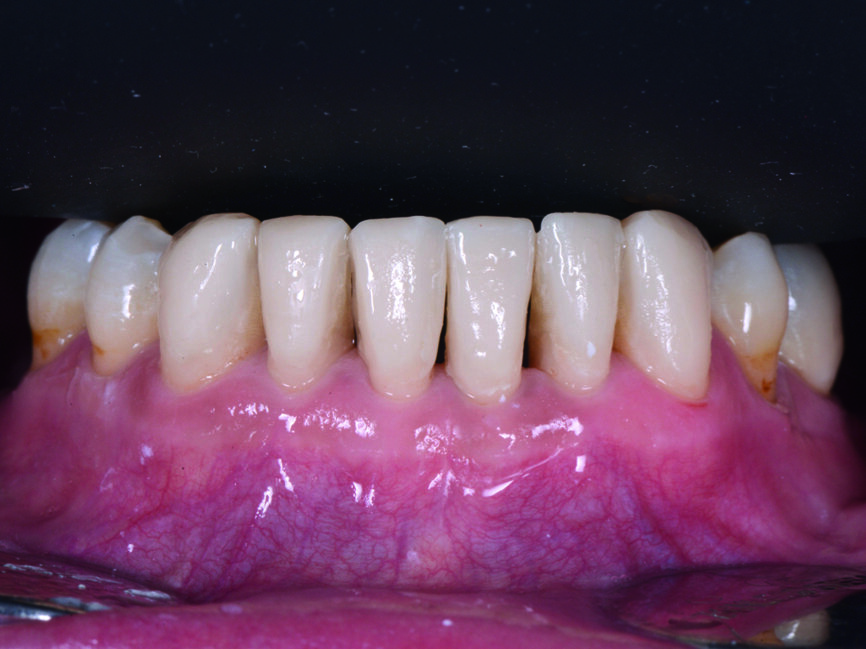 Fig. 20 : Vue postopératoire des dents inférieures restaurées par des composites injectés en technique directe. 