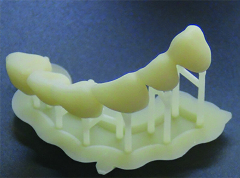 Fig. 21b: 3D printing with Form 2 resin for a complete removable prosthesis (denture base and denture teeth). Denture tooth resin is used for both prosthetic teeth for removable prostheses and temporary teeth.