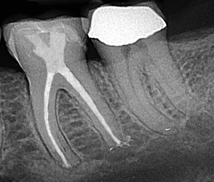 Fig. 10 : Radiographie postopératoire d’une molaire inférieure traitée par une autre configuration en ferme – une cavité d’accès avec « orifice en X » – un motif qui minimise l’élimination de structure dentaire dans la partie critique de la dent (cas de l’auteur).