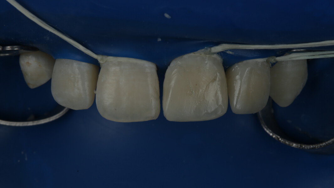 Fig 30: Final A2 Enamel was used for outer layer giving it proper contour and final form. 