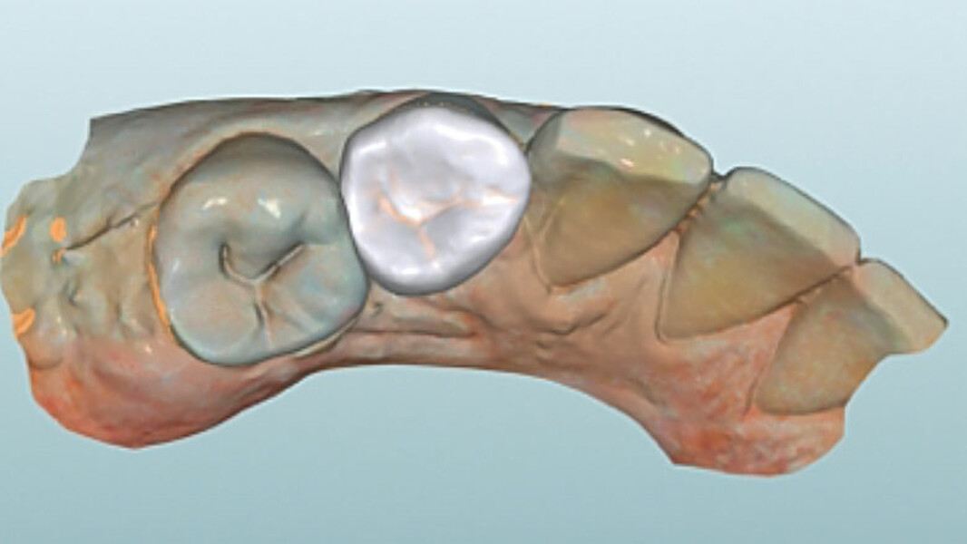 Fig. 8. Vista oclusal de la endocorona virtual en el software CAD.