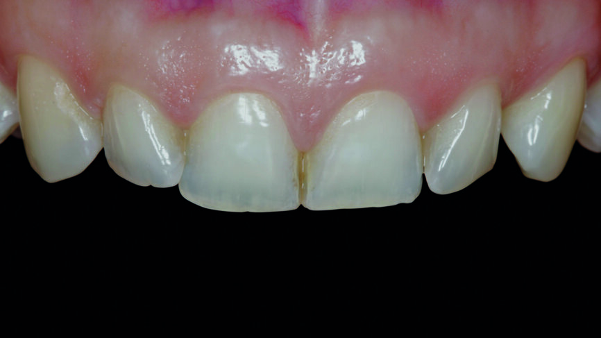 Fig. 1 : Photographie initiale des dents antérieures avant le traitement orthodontique