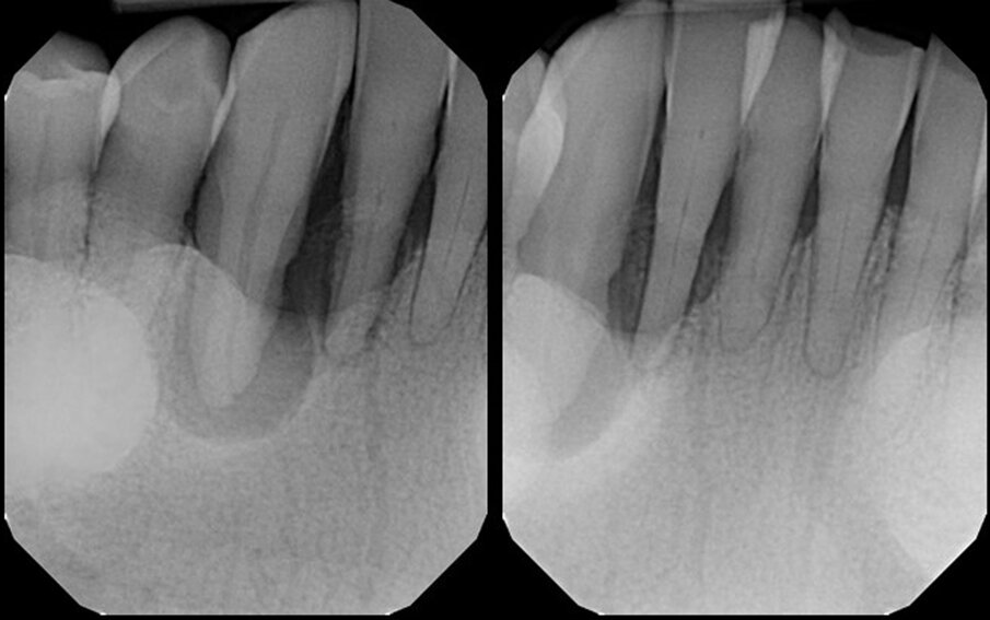Figs. 1a & b: Pretreatment radiograph demonstrating signicant bone loss associated with the mandibular right central incisor, lateral incisor and canine.