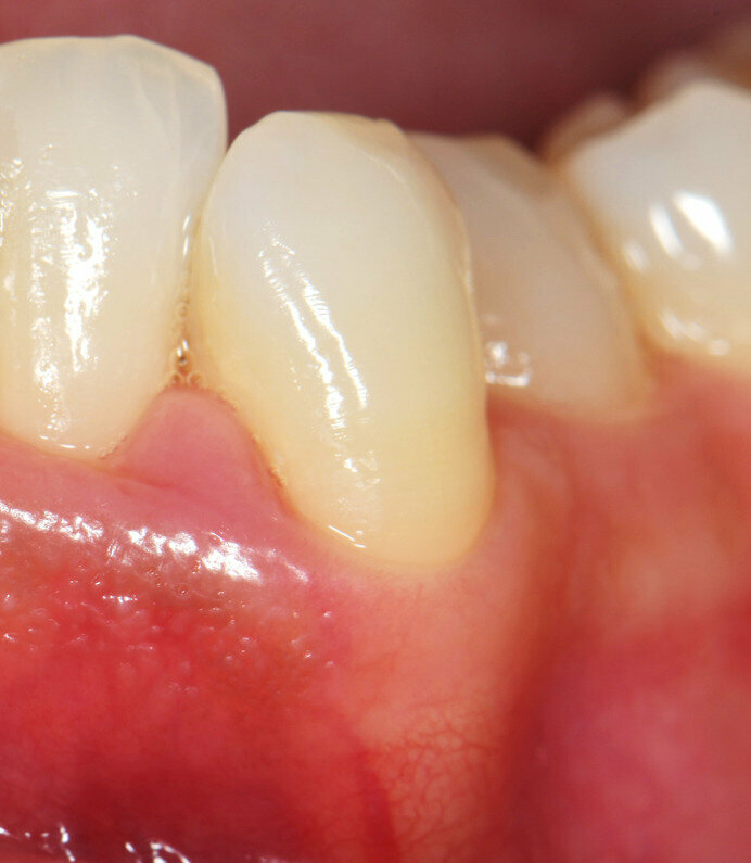 Fig. 3 - Caso clinico illustrativo. Visione frontale del difetto iniziale. I tessuti appaiono edematosi, la papilla interdentale è rigonfia e distaccata dalle superfici dei denti contigui.
