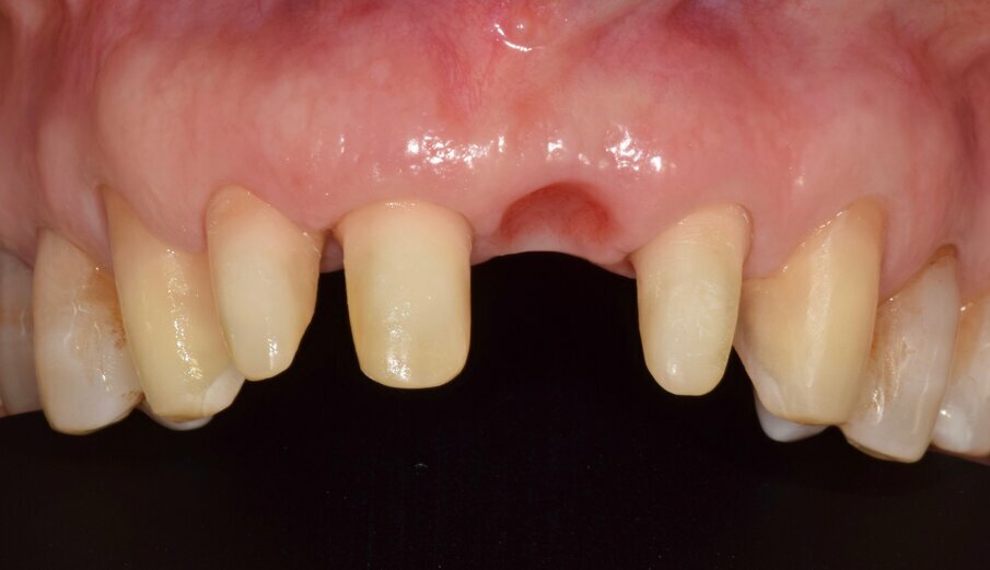 Fig. 8: Tooth preparation cleaned with KATANA Cleaner before adhesive application and resin cementation.