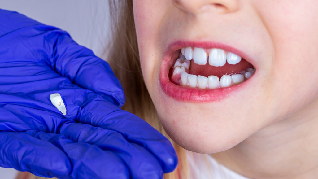 Đường mọc của răng chính có thể giúp đánh giá nguy cơ phát triển các rối loạn tâm thần