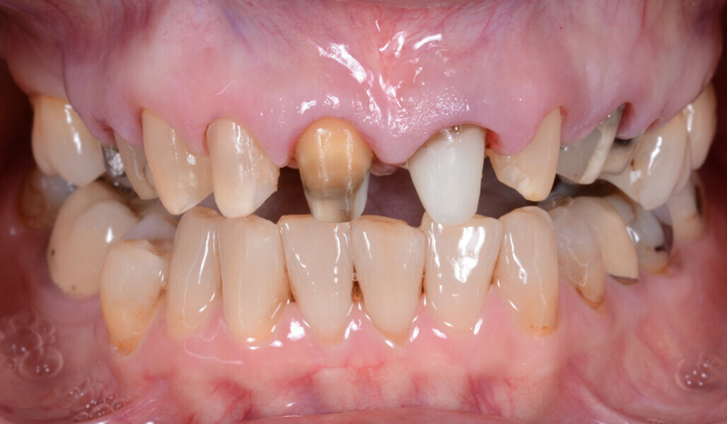 Fig. 6: Situation after tooth preparation. A heavily discoloured central incisor.