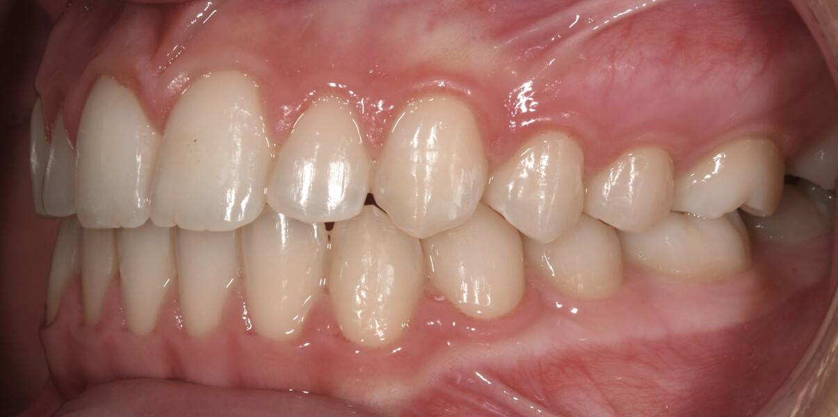 Fig. 21: Final intra-oral photograph. 