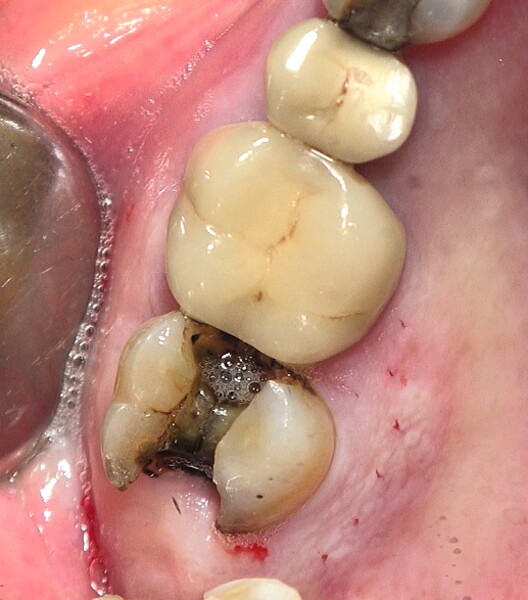 Fig. 48 : Deuxième molaire supérieure compromise (fissure et complication endodontique). 