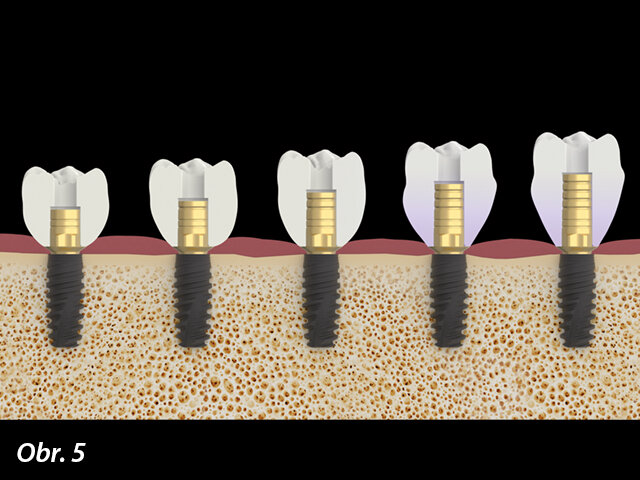 Titanové báze K85 je možné individuálně zkrátit za účelem optimálního uzpůsobení délce zubu.