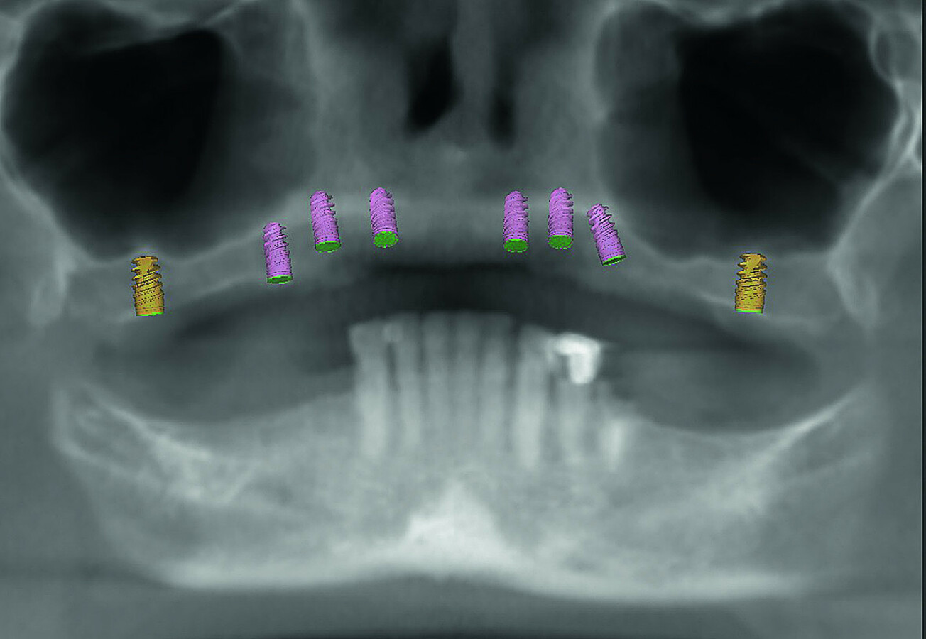 Incorporating CAD/CAM solutions for full-mouth dental implant ...