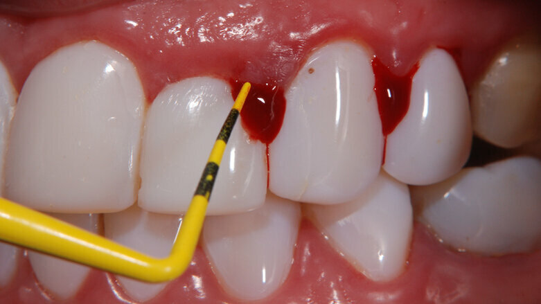 Mitos del blanqueamiento dental