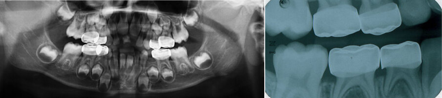 Figure 11 (a & b). The Hall technique: Figure (11a) shows an OPG radiograph taken at follow up for the same patient seen in Figure 10. There were no clinical or radiographic signs or symptoms of pulpal pathosis. Figure (11b) shows a right bitewing radiograph follow up of SSC using the Hall technique. It shows adequate coverage of the primary molars.