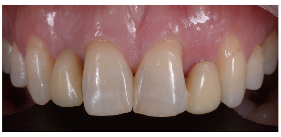 Fig. 15_Paziente da trattare con evidenti disarmonie tissutali e dentali.
