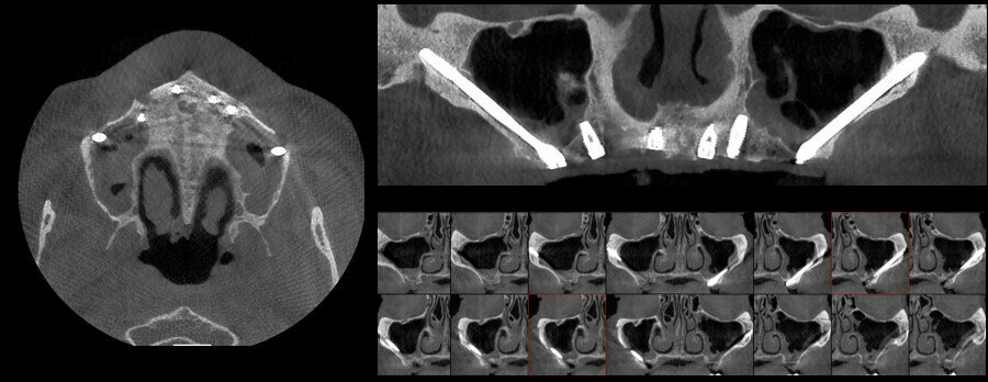 Figs. 10a–c: Final CT scan with cross-sectional (a), coronal (b) and sagittal (c) views.