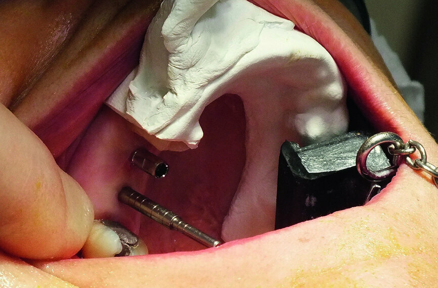 Fig. 11: A guide pin was placed in the upper right first molar site to check the depth and alignment.