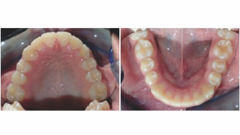 After the mandibular advancement phase, the patient switched from 2-week aligner changes to the current 1-week aligner change interval.