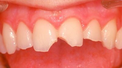Il punto di vista dell’odontologo forense nella valutazione dei traumi dentali
