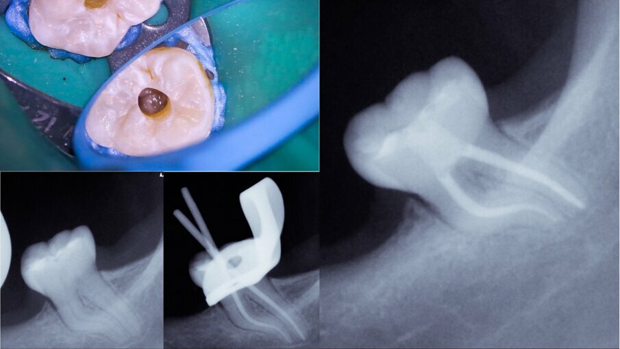 Figs. 4a–d: Root canal therapy performed through a conservative access cavity in a tooth #37 with severe curvatures at the mesial root. The root canal obturation was performed by the hydraulic compaction technique.