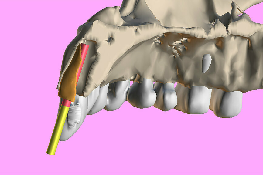 Fig. 5a: Virtual sectioning of the segmented root using Meshmixer with a simulated custom implant to reach the root apex.