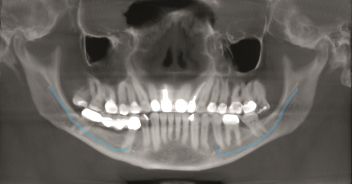 Fig. 13 : Tracé du trajet du canal mandibulaire.