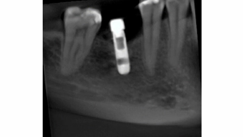 Fig 4. Tomografía a los 9 meses. El halo hipodenso en la parte distal del implante ya no existe, ni en la parte inferior, así como tampoco en la parte del reborde óseo; se sigue realizando terapia de fotobioestimulación en la zona.