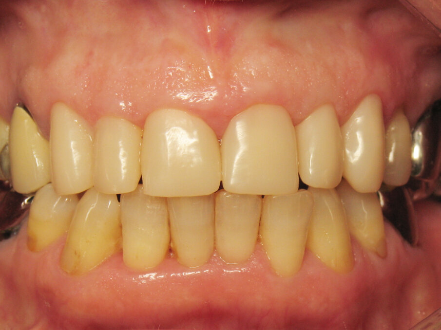 Fig. 8: Try-in of provisional crowns.