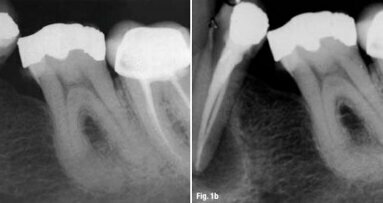 Endodontie : est-ce l'affaire de la biologie ?