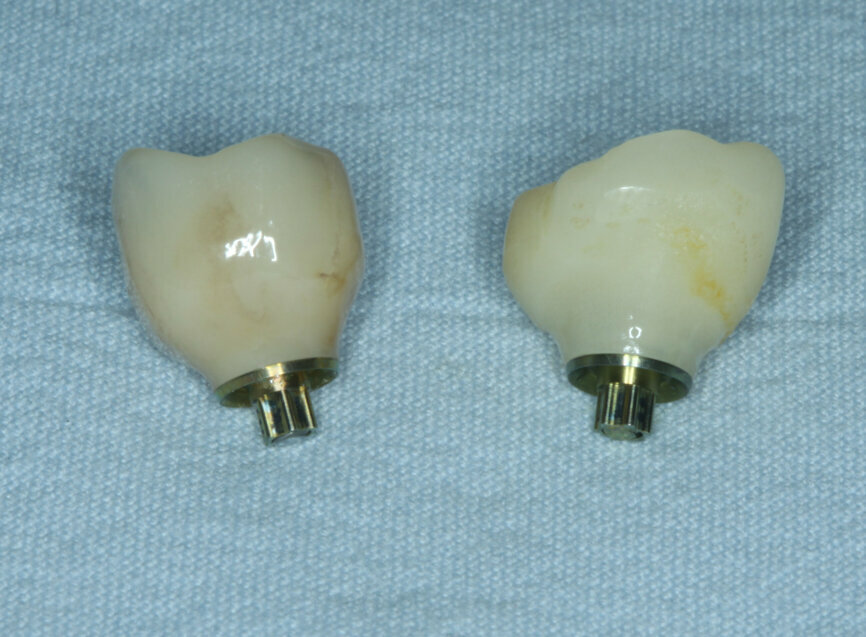 Fig. 23: Temporary crown removed and monolithic zirconia crown ready for insertion.