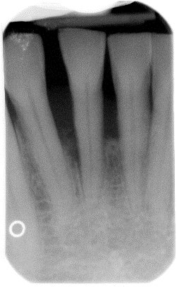 Fig. 6c - Radiografia iniziale.