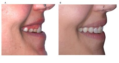 Piano di trattamento digitale in un caso di agenesia dentale multipla anteriore